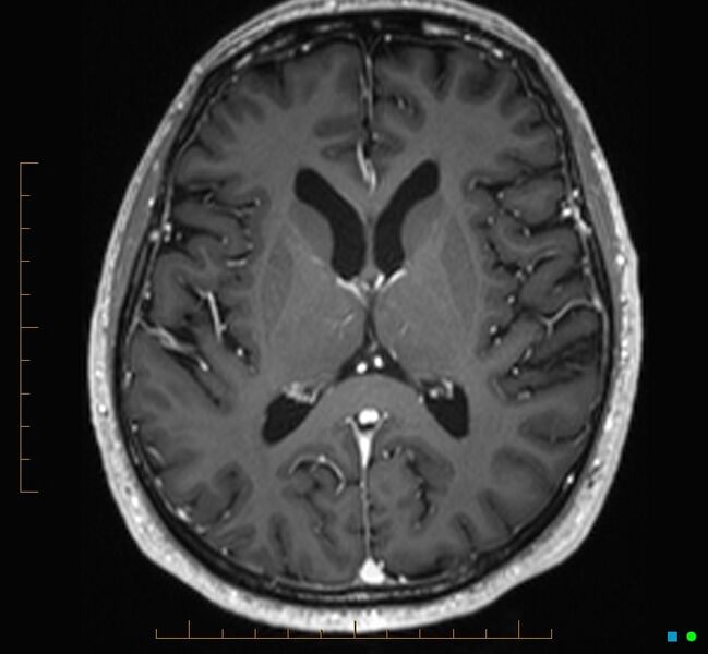 File:Cerebellar gangliocytoma (Radiopaedia 65377-74422 Axial T1 C+ 71).jpg