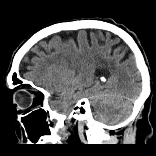 File:Cerebellar hemorrhage (Radiopaedia 27193-27359 C 15).jpg