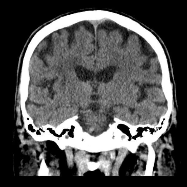 File:Cerebellar hemorrhage (Radiopaedia 27193-27359 Coronal non-contrast 31).jpg