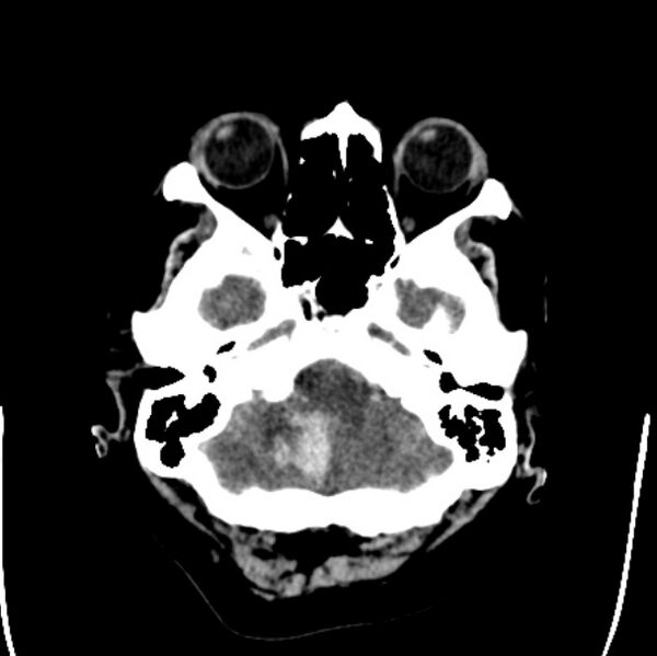 File:Cerebellar hemorrhage causing obstructive hydrocephalus (Radiopaedia 33989-35207 Axial non-contrast 8).jpg