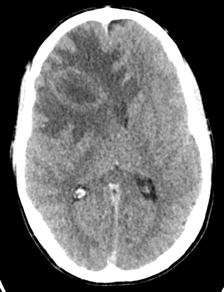 File:Cerebral abscess (Radiopaedia 60342-68008 Axial non-contrast 28).png