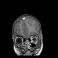 Cerebral abscess post cardiac surgery (Radiopaedia 27244-27420 Coronal T1 C+ 2).jpg