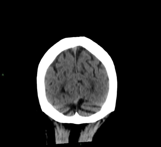 File:Cerebral amyloid angiopathy-associated lobar intracerebral hemorrhage (Radiopaedia 58376-65513 Coronal non-contrast 22).jpg