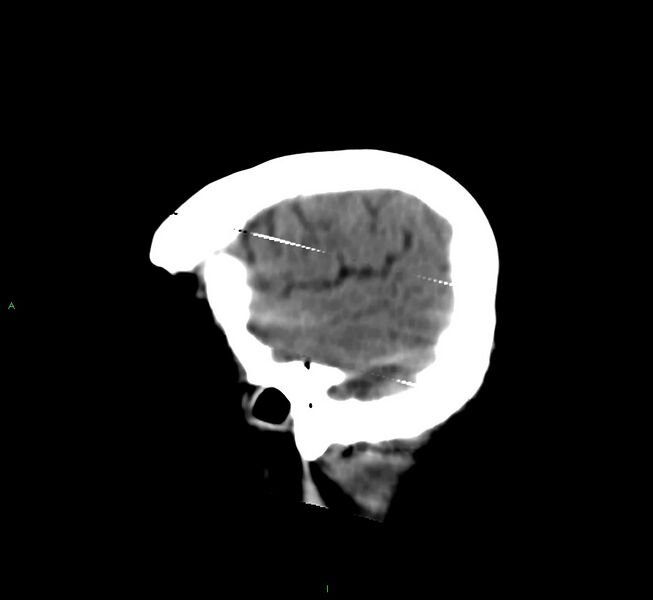 File:Cerebral amyloid angiopathy-associated lobar intracerebral hemorrhage (Radiopaedia 58377-65514 B 7).jpg