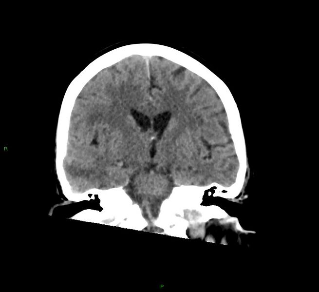 File:Cerebral amyloid angiopathy-associated lobar intracerebral hemorrhage (Radiopaedia 58378-65516 Coronal non-contrast 33).jpg