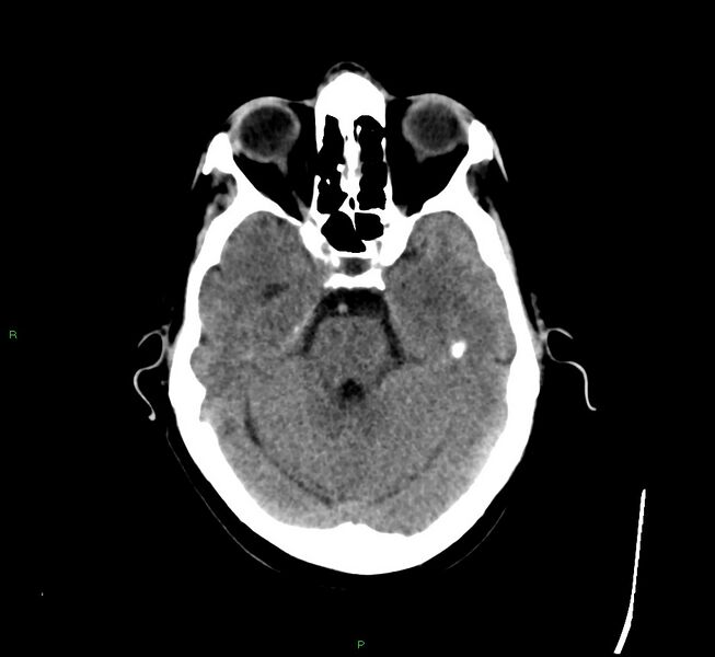 File:Cerebral amyloid angiopathy-associated lobar intracerebral hemorrhage (Radiopaedia 58529-65681 Axial non-contrast 36).jpg