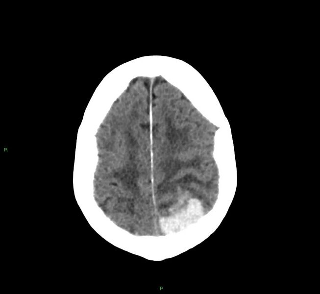 File:Cerebral amyloid angiopathy-associated lobar intracerebral hemorrhage (Radiopaedia 58530-65688 Axial non-contrast 10).jpg