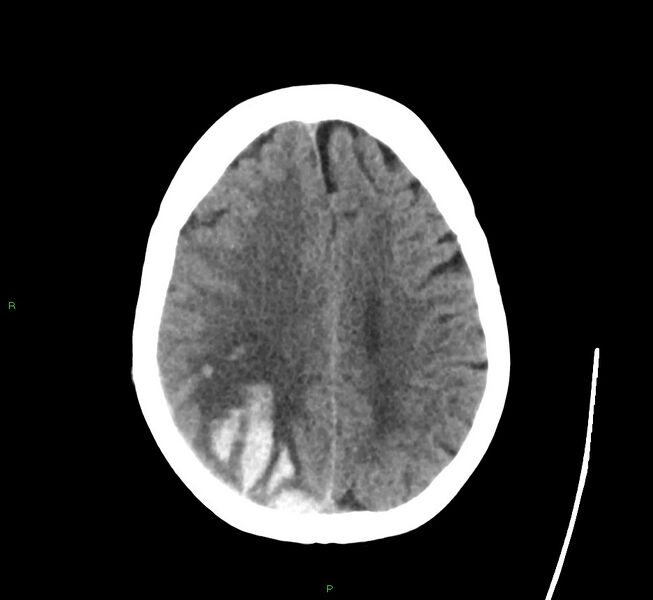 File:Cerebral amyloid angiopathy-associated lobar intracerebral hemorrhage (Radiopaedia 58563-65727 Axial non-contrast 19).jpg