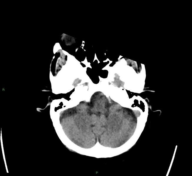 File:Cerebral amyloid angiopathy-associated lobar intracerebral hemorrhage (Radiopaedia 58563-65727 Axial non-contrast 43).jpg