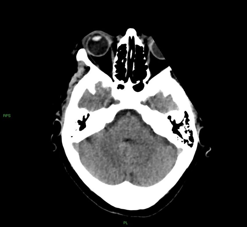 Cerebral amyloid angiopathy-associated lobar intracerebral hemorrhage (Radiopaedia 58569-65734 Axial non-contrast 45).jpg