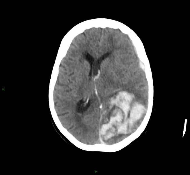 File:Cerebral amyloid angiopathy-associated lobar intracerebral hemorrhage (Radiopaedia 58754-65975 Axial non-contrast 32).jpg