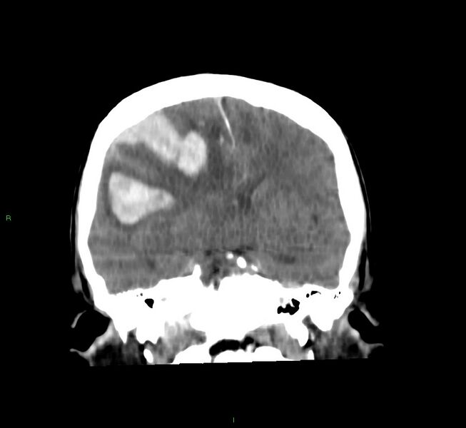 File:Cerebral amyloid angiopathy-associated lobar intracerebral hemorrhage (Radiopaedia 58756-65977 Coronal non-contrast 37).jpg