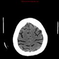 Cerebral and orbital tuberculomas (Radiopaedia 13308-13310 Axial non-contrast 24).jpg
