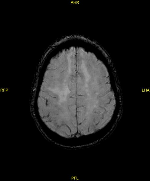 File:Cerebral autosomal dominant arteriopathy with subcortical infarcts and leukoencephalopathy (CADASIL) (Radiopaedia 86108-102054 Axial SWI 82).jpg