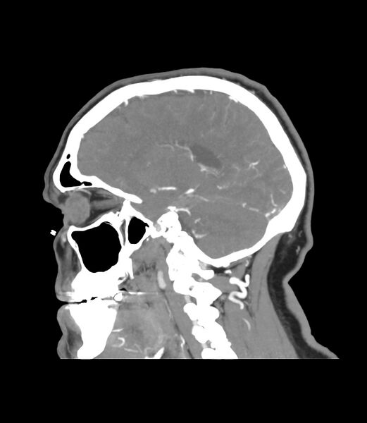 File:Cerebral dural venous sinus thrombosis (Radiopaedia 86514-102576 C 19).jpg