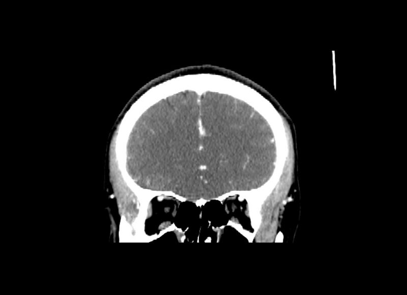 File:Cerebral edema (Radiopaedia 82519-96661 C 46).jpg