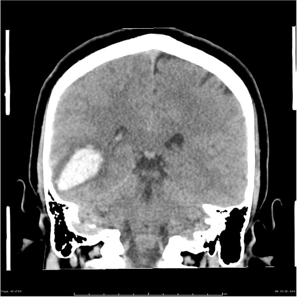 File:Cerebral hemorrhage secondary to arteriovenous malformation (Radiopaedia 33497-34561 Coronal non-contrast 33).jpg