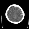 Cerebral hemorrhagic contusions (Radiopaedia 23145-23188 Axial non-contrast 32).jpg