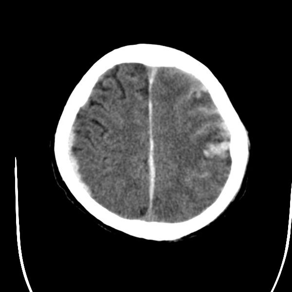 File:Cerebral hemorrhagic contusions (Radiopaedia 23145-23188 Axial non-contrast 32).jpg