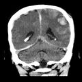 Cerebral hemorrhagic contusions (Radiopaedia 23145-23188 Coronal non-contrast 30).jpg