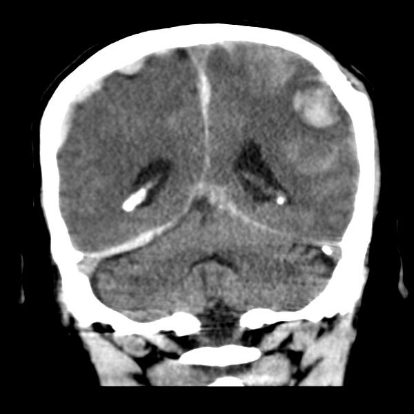 File:Cerebral hemorrhagic contusions (Radiopaedia 23145-23188 Coronal non-contrast 30).jpg