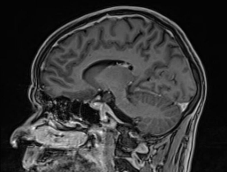 File:Cerebral venous thrombosis (Radiopaedia 71207-81504 Sagittal T1 C+ 36).jpg