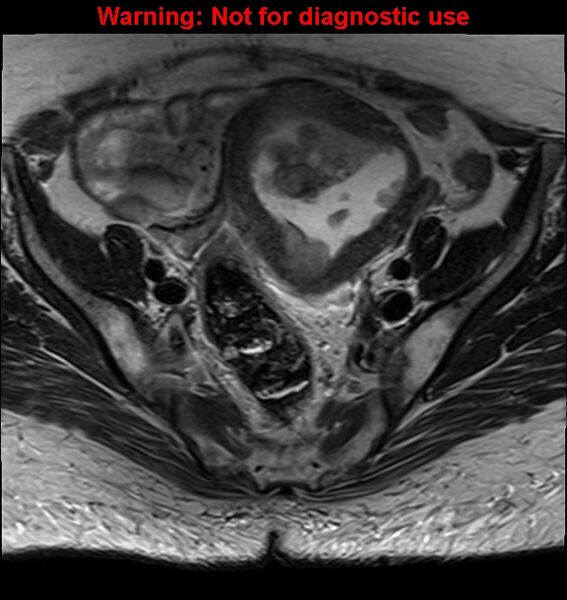 File:Cervical cancer (Radiopaedia 24151-24410 Axial T2 10).jpg
