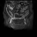 Cervical carcinoma (Radiopaedia 78847-91705 J 3).jpg