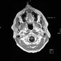 Cervical dural CSF leak on MRI and CT treated by blood patch (Radiopaedia 49748-54995 Axial T1 C+ 10).jpg
