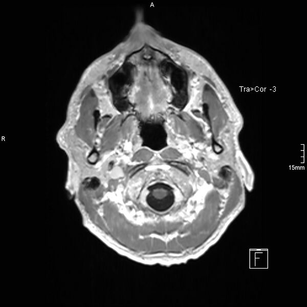 File:Cervical dural CSF leak on MRI and CT treated by blood patch (Radiopaedia 49748-54995 Axial T1 C+ 10).jpg