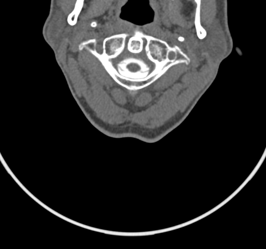 Cervical dural CSF leak on MRI and CT treated by blood patch (Radiopaedia 49748-54996 B 13).png