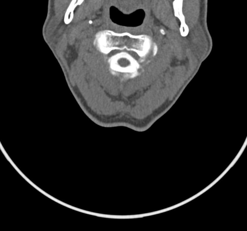 Cervical dural CSF leak on MRI and CT treated by blood patch (Radiopaedia 49748-54996 B 18).png