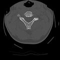 Cervical flexion teardrop fracture with cord hemorrhage (Radiopaedia 32497-33454 Axial bone window 28).jpg