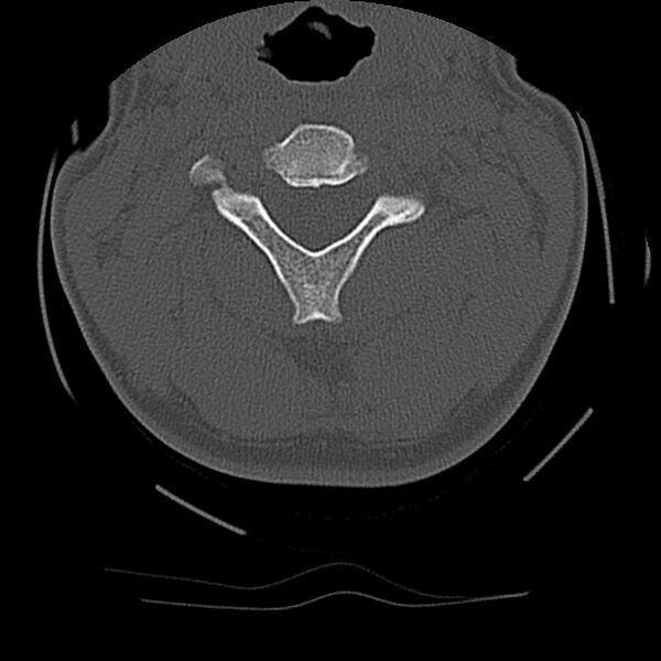File:Cervical flexion teardrop fracture with cord hemorrhage (Radiopaedia 32497-33454 Axial bone window 28).jpg