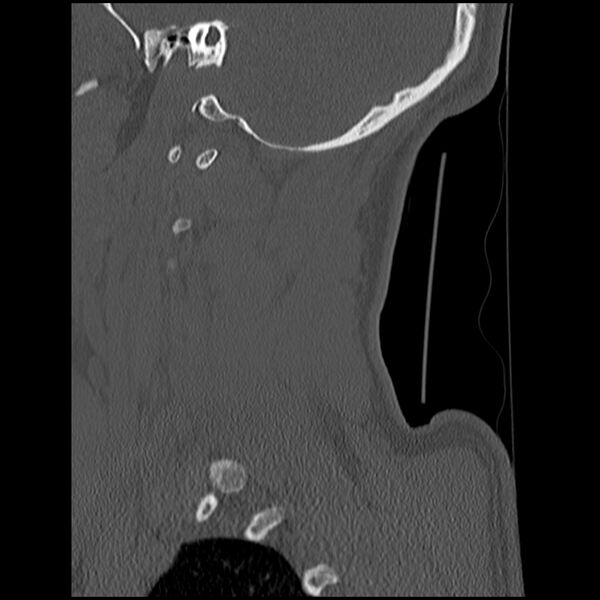 File:Cervical flexion teardrop fracture with cord hemorrhage (Radiopaedia 32497-33454 Sagittal bone window 6).jpg