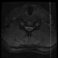 Cervical flexion teardrop fracture with cord hemorrhage (Radiopaedia 32497-33455 Axial Gradient Echo 20).jpg