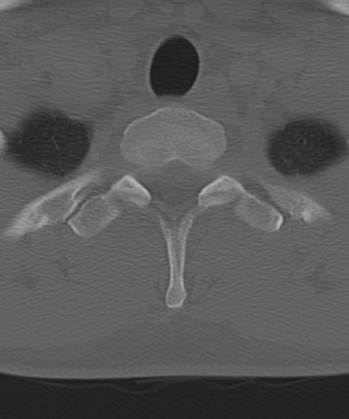 File:Cervical intercalary bone (Radiopaedia 35211-36748 Axial bone window 61).png