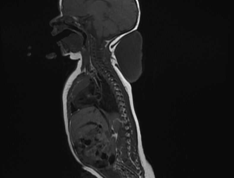 File:Cervical myelomeningocele (Radiopaedia 69569-79479 Sagittal T1 5).jpg