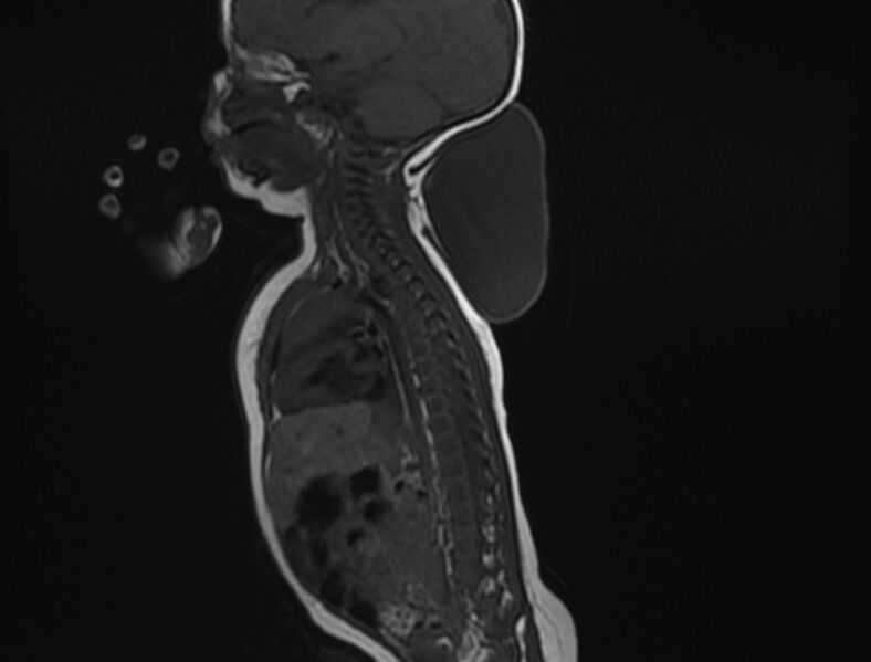 File:Cervical myelomeningocele (Radiopaedia 69569-79479 Sagittal T1 9).jpg