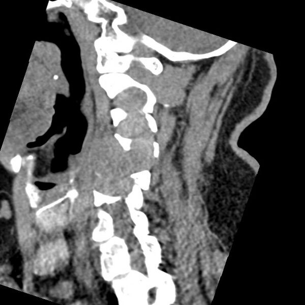 File:Cervical spinal neurofibroma in a patient with NF1 (Radiopaedia 58344-65464 C 20).jpg