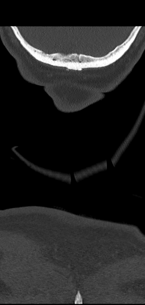 File:Cervical spine fracture - chalk stick (Radiopaedia 39116-41323 Coronal bone window 66).png