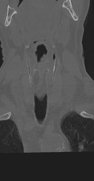 File:Cervical spine fracture in the setting of ankylosis (Radiopaedia 37038-38715 Coronal bone window 6).png