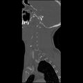 Cervical spine fractures with vertebral artery dissection (Radiopaedia 32135-33078 Sagittal bone window 35).jpg
