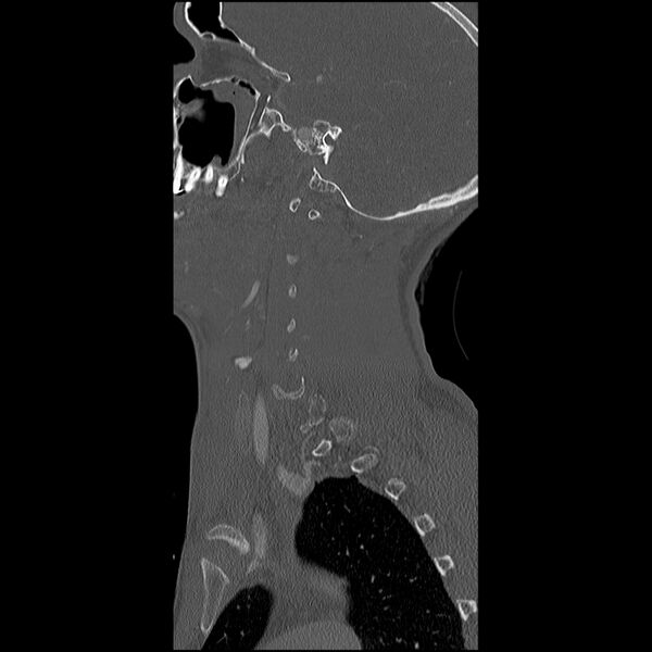 File:Cervical spine fractures with vertebral artery dissection (Radiopaedia 32135-33078 Sagittal bone window 35).jpg