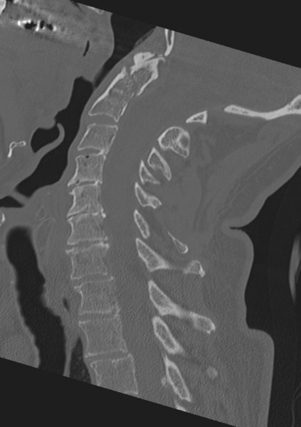 File:Cervical spine fractures with vertebral artery dissection (Radiopaedia 53296-59268 Sagittal bone window 36).png
