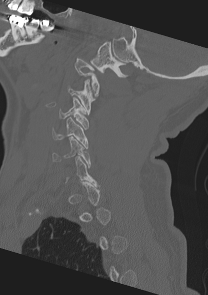 File:Cervical spine fractures with vertebral artery dissection (Radiopaedia 53296-59268 Sagittal bone window 50).png