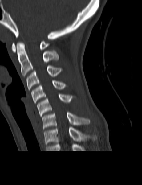 File:Cervical spine posterior ligamentous complex rupture (Radiopaedia 63486-72101 Sagittal bone window 12).jpg