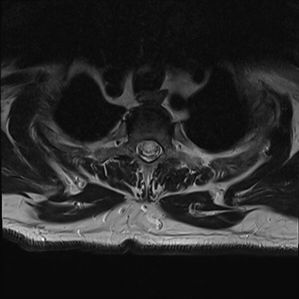File:Cervical tumor-like myelopathy due to Type V dAVF (Radiopaedia 82461-96604 D 2).jpg
