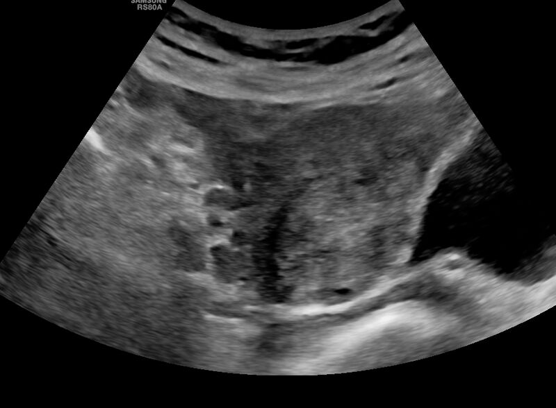 File:Cesarean scar ectopic pregnancy (Radiopaedia 77286-89726 Transverse 1).jpg