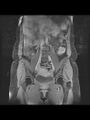 Cesarean section scar endometrioma (Radiopaedia 56569-63297 Coronal STIR 13).jpg